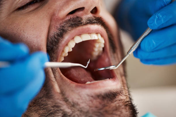Best Emergency Wisdom Teeth Removal in New Franklin, OH